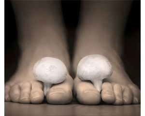 Грибок на ногах: симптомы, причины и эффективная профилактика