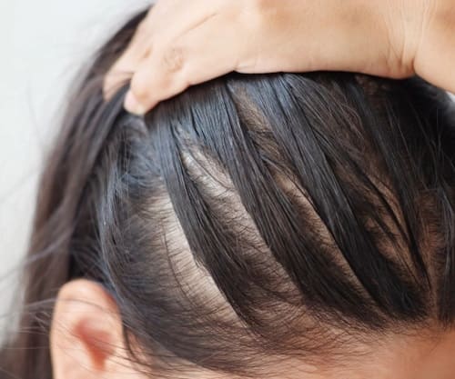 Почему волосы засыпают и редеют?