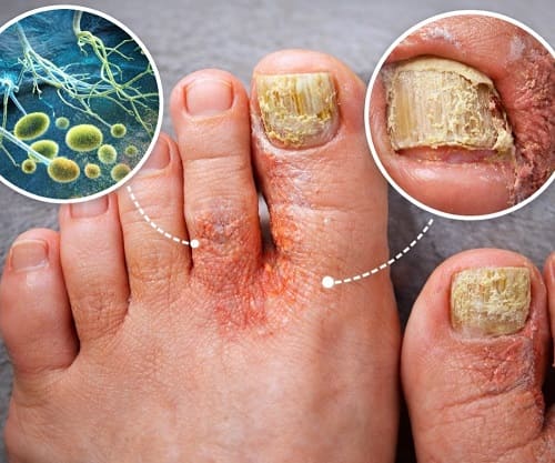 грибок на ногах