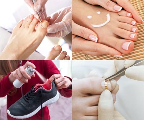 як лікувати грибок на ногах