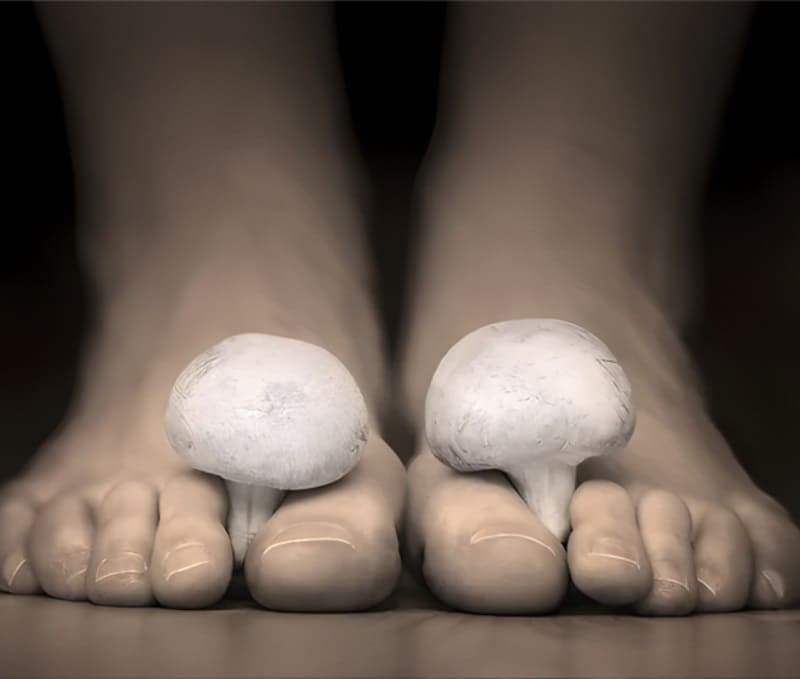 Грибок на ногах: симптомы, причины и эффективная профилактика