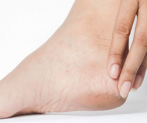 Тріщини на п’ятах