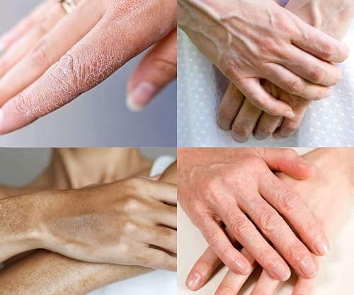 Признаки старения рук