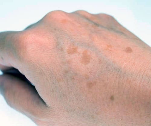 пігментні плями на руках