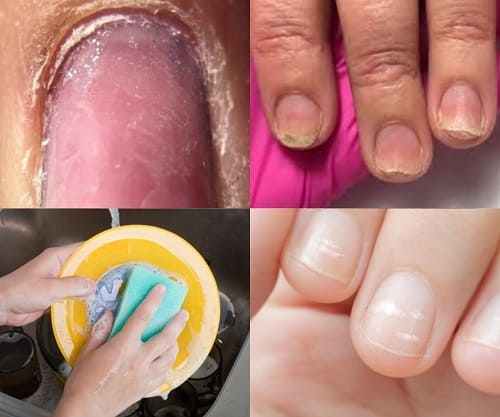 Почему ногти становятся тонкими