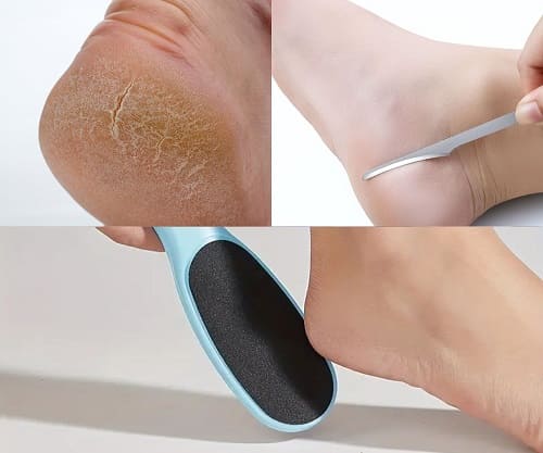 чего нельзя делать когда сухие стопы