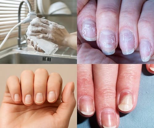 причины повреждения ногтей